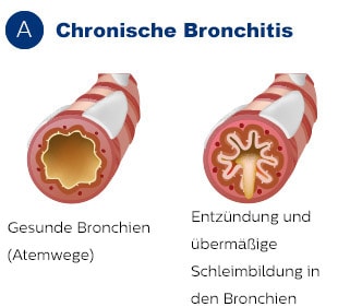 Auswirkungen der chronischen Bronchitis auf die Bronchien
