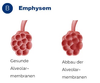 Auswirkungen des Emphysems auf die Alveolen