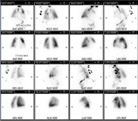 Thorax Spektral CT