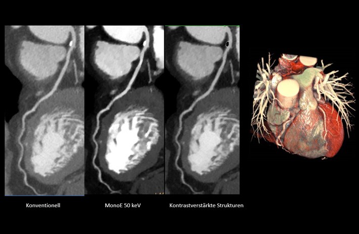 Kardiologische CTA Untersuchung