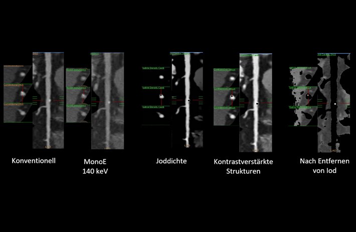 Reduzierung von Blooming Artefakten in Kardiologie