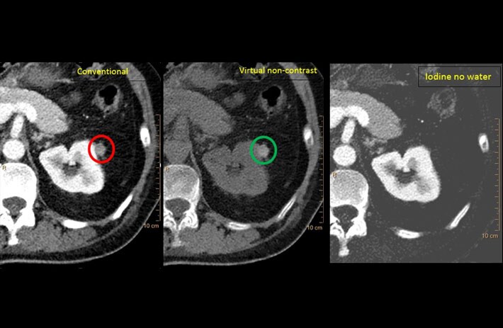 Abdominale Schmerzen und Hämaturie