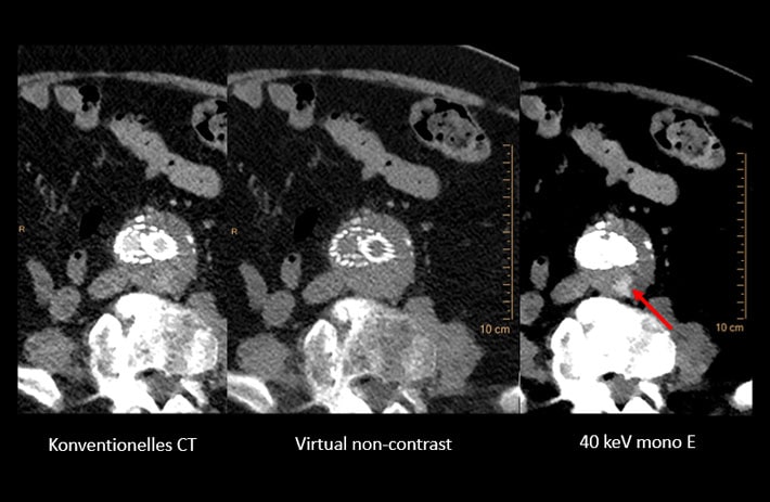 Endoleak CTA Thorax und Abdomen