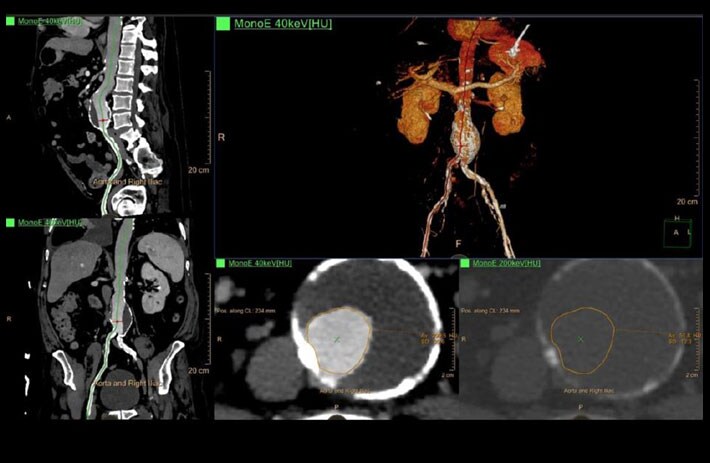 CTA Abdomen zur EVAR-Planung