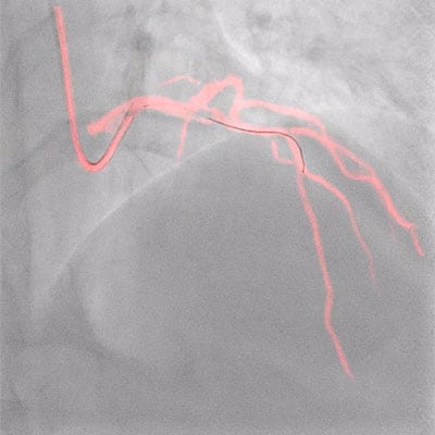 Philips Coronary Roadmap