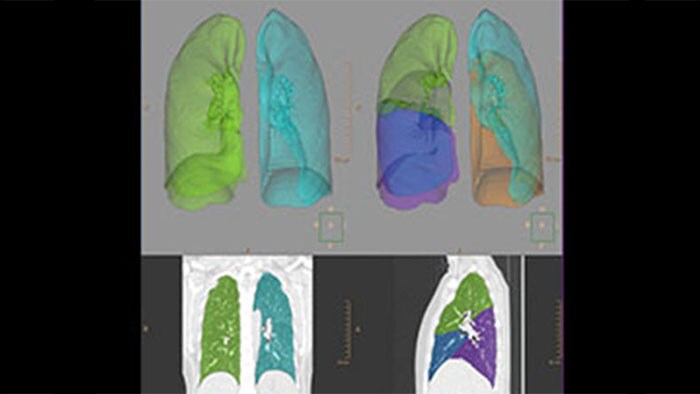Radiologische Scan-Bilder der menschlichen Lunge