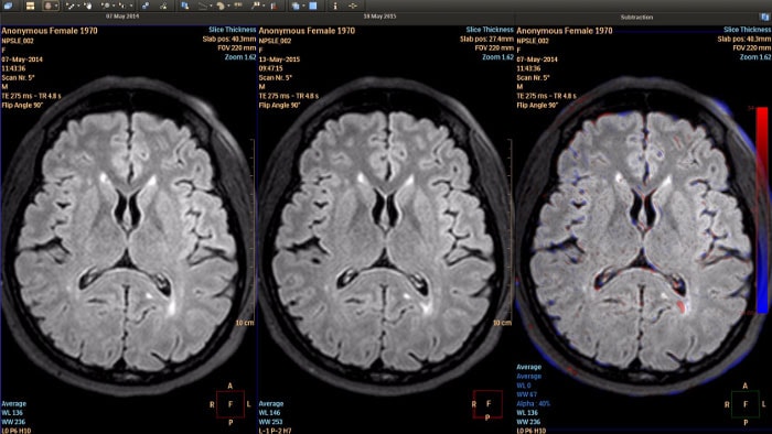 MR Longitudinal Brain Imaging