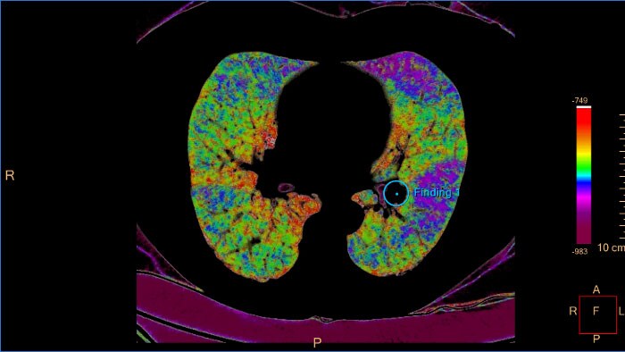 CT Pulmonary Artery Analysis CB Farbskala