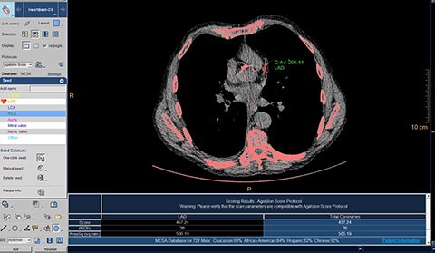 ct calcium scoring clinical image
