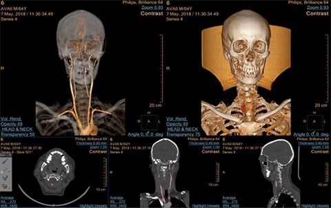 multi modality advanced vessel analysis clinical image