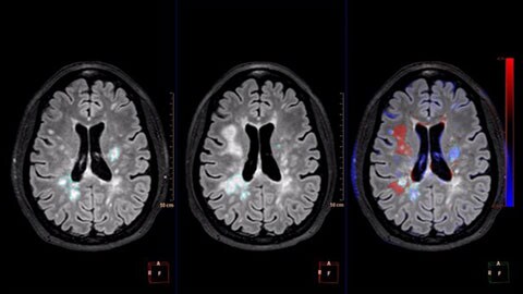 mr longitudinal brain imaging clinical image