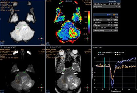 mr t2 neuro perfusion clinical image