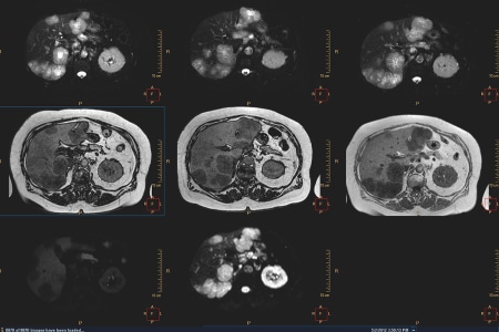 Multi Modality Tumor Tracking