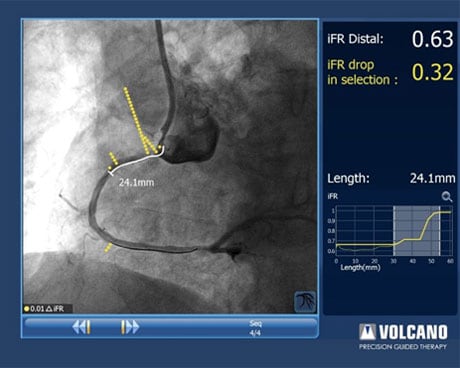 ifr coreg focal disease