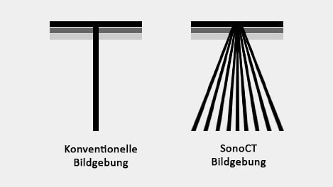 Vergleich der Funktionsweise konventioneller Bildgebung und SonoCT Bildgebung​