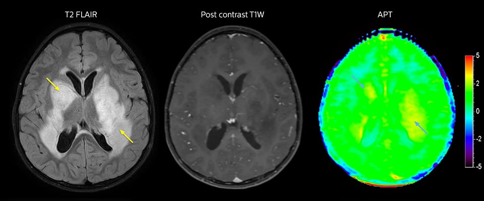 APT-Bildgebung eines niedrig differenzierten Tumors