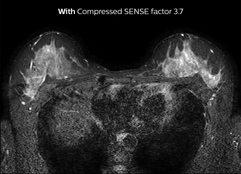 2D STIR breast Compressed SENSE factor3.7