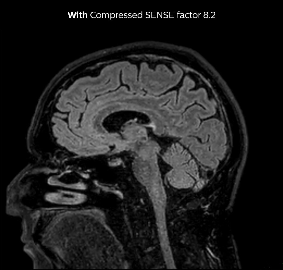 3D FLAIR brain Compressed SENSE factor8.2