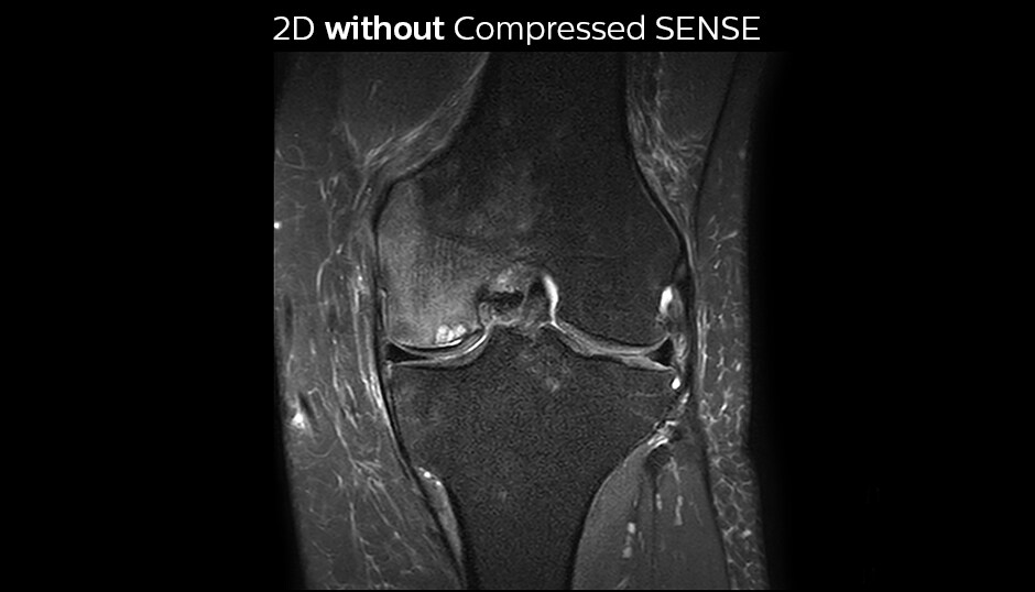 PD FS SPAIR knee without Compressed SENSE cor bild