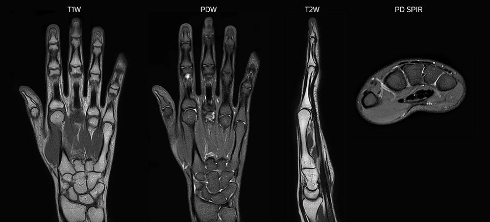 MRT Hand und Handgelenk mit großem FOV