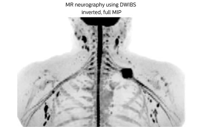MR-Neurographie mit invertierter, diffusionsgewichteter MRT, volle MIP