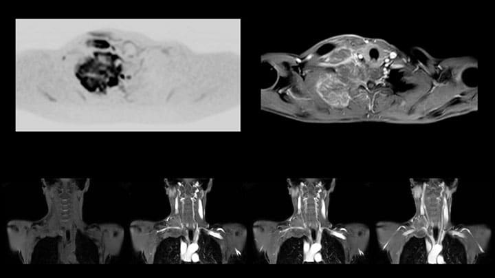 MRT Pancoast-Tumor