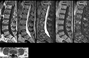 MR-Scan zur Ermittlung der Ursache für Rückenschmerzen