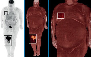 Streustrahlenkorrektur mit xClean für höhere Bildgenauigkeit bei Scans von adipösen Menschen​