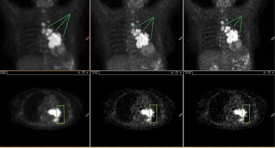 PET/CT Bilder mit xSharp und xFine rekonstruiert für hohen Kontrast​