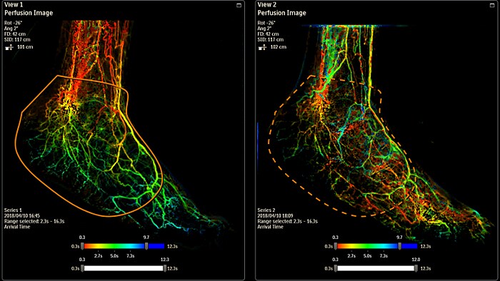 SmartPerfusion