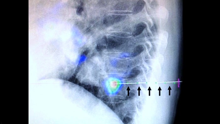 XperGuide und CBCT