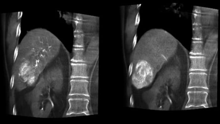 Optimierte Darstellung von Arterien und Tumoren mit CBCT Dual