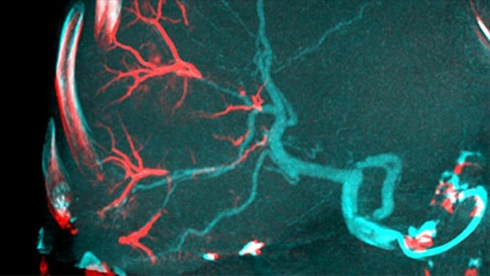 Fusion von 3D-Bildern vor und nach der Embolisation mit Dual View