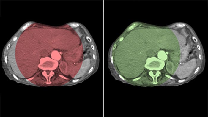 Vollständige Abdeckung der Leber mit CBCT Open