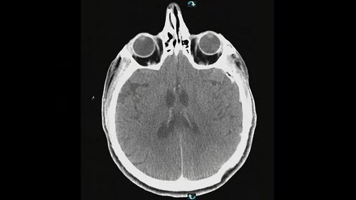 Zerebrales Aneurysma