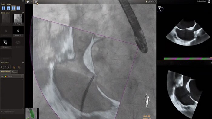 EchoNav Modelle Aorta Mitral