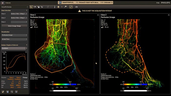 SmartPerfusion