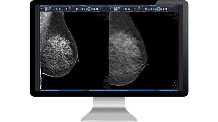 Mammographie bild