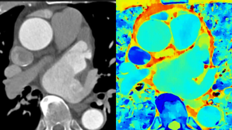 Herkömmliches klinisches CT-Bild im Vergleich zum Spektral-Detektor-CT-Bild aus dem klinischen Bereich