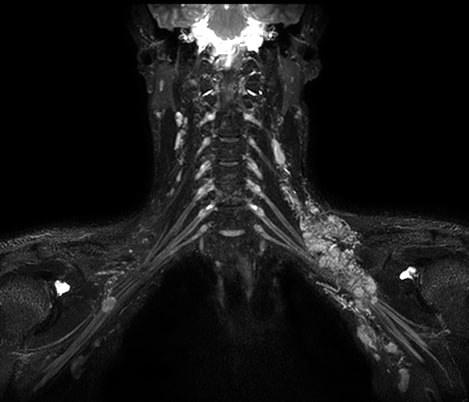 Nichtinvasive Untersuchung des Nervenplexus​