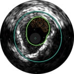 Thrombus Bild