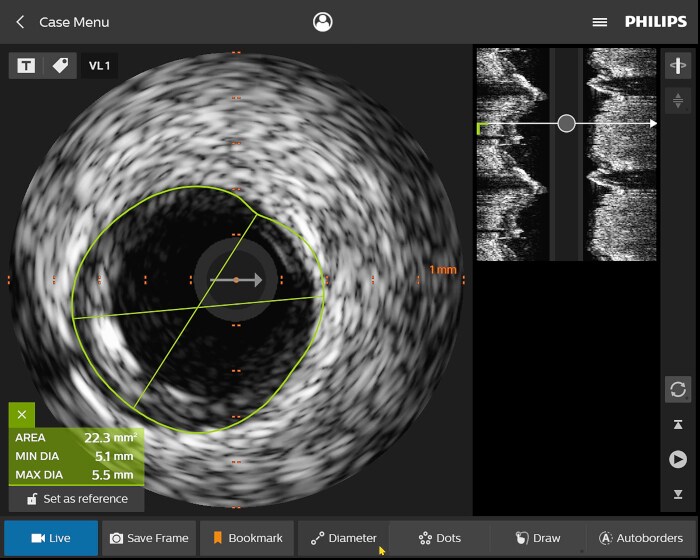 Standbild IntraSight IVUS-Fallmenü