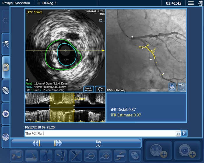 Video IntraSight Triregistrierung