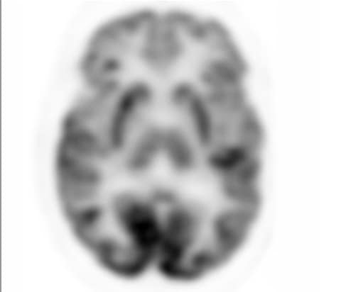 Analoger PET-Scan des Gehirns