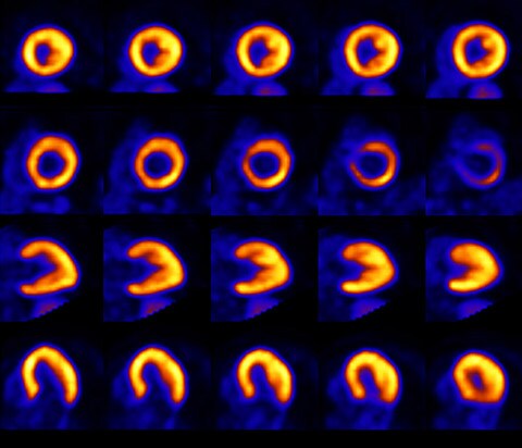 Analoger PET-Scan des Herzens