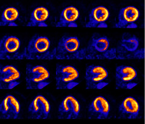 Digitaler PET-Scan des Herzens mit Vereos