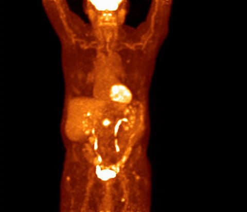 Analoger PET-Scan des Thoraxes