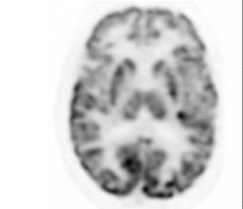 Digitaler PET-Scan des Gehirns mit Vereos