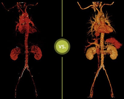 Klassische CT vs. IQon Spektral CT