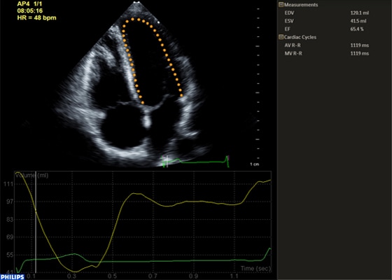Anatomische Intelligenz zur automatischen 2D-Quantifizierung des Ultraschalls eines Herzens​